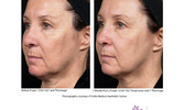 ThermaFrax Anti Aging Treatments